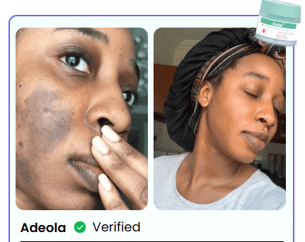 TACHES BRUNES, HYPERPIGMENTATION DU MÉLASMA ?