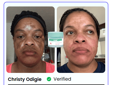 TACHES BRUNES, HYPERPIGMENTATION DU MÉLASMA ?