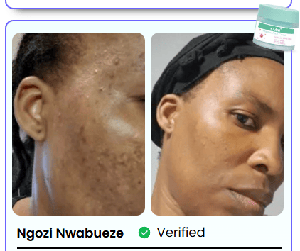 TACHES BRUNES, HYPERPIGMENTATION DU MÉLASMA ?