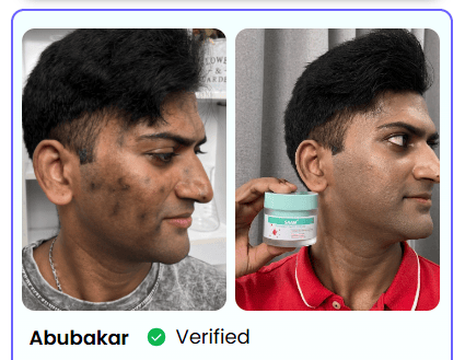 TACHES BRUNES, HYPERPIGMENTATION DU MÉLASMA ?